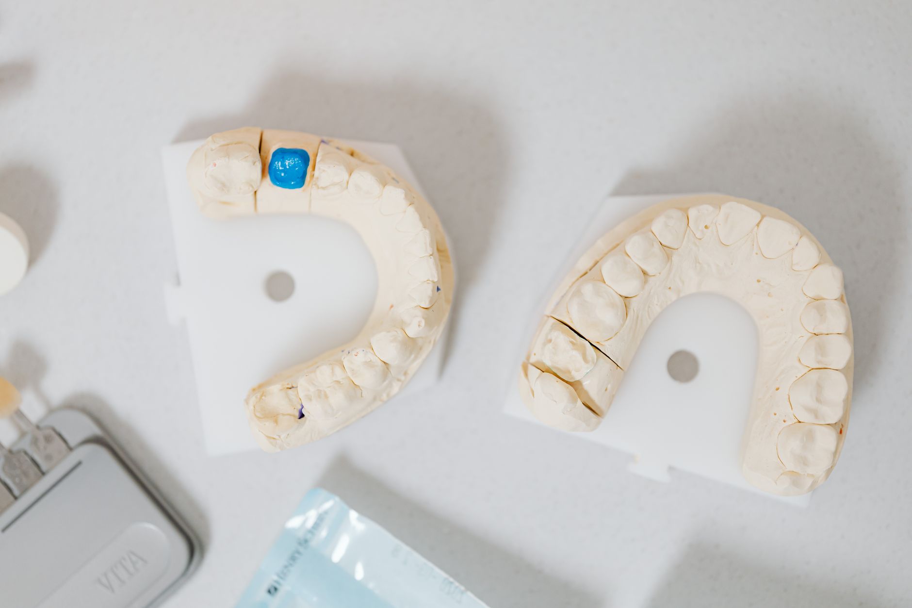 Schéma d'un pont fixe traditionnel appuyé sur deux couronnes posées sur les dents voisines