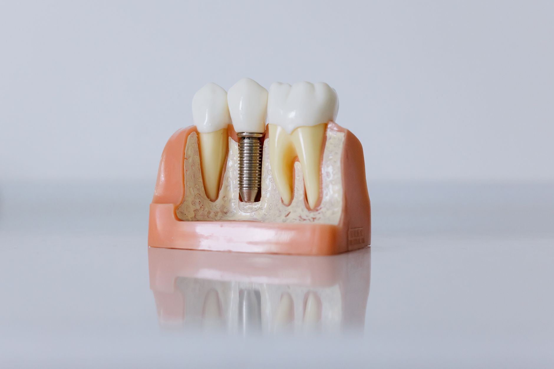 Schéma d'une couronne sur implant montrant le pilier et la vis en titane ancrés dans l'os de la mâchoire