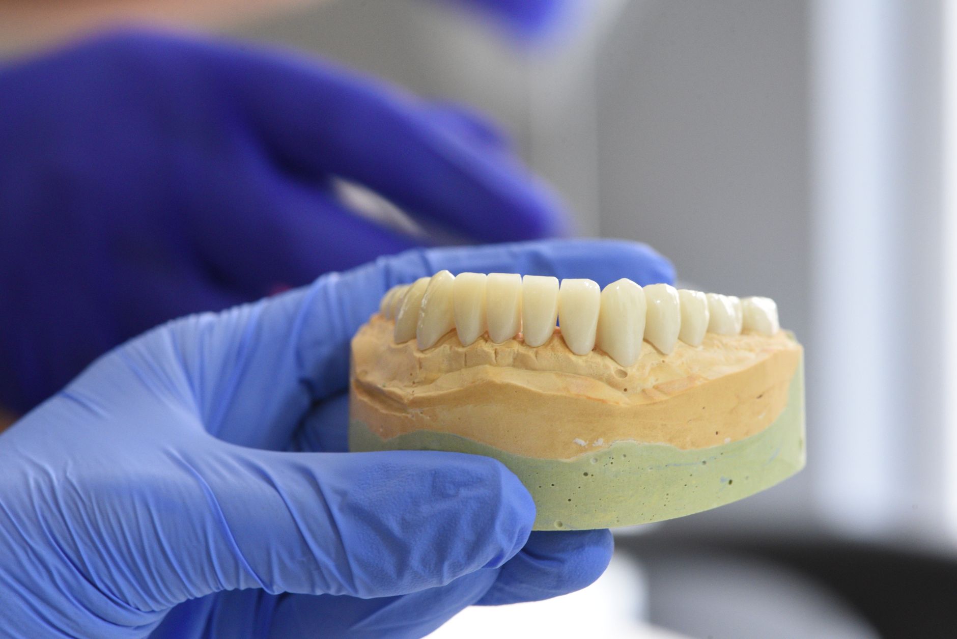 Couronne en zircone posée sur un implant, gros plan d'un sourire naturel après la restauration