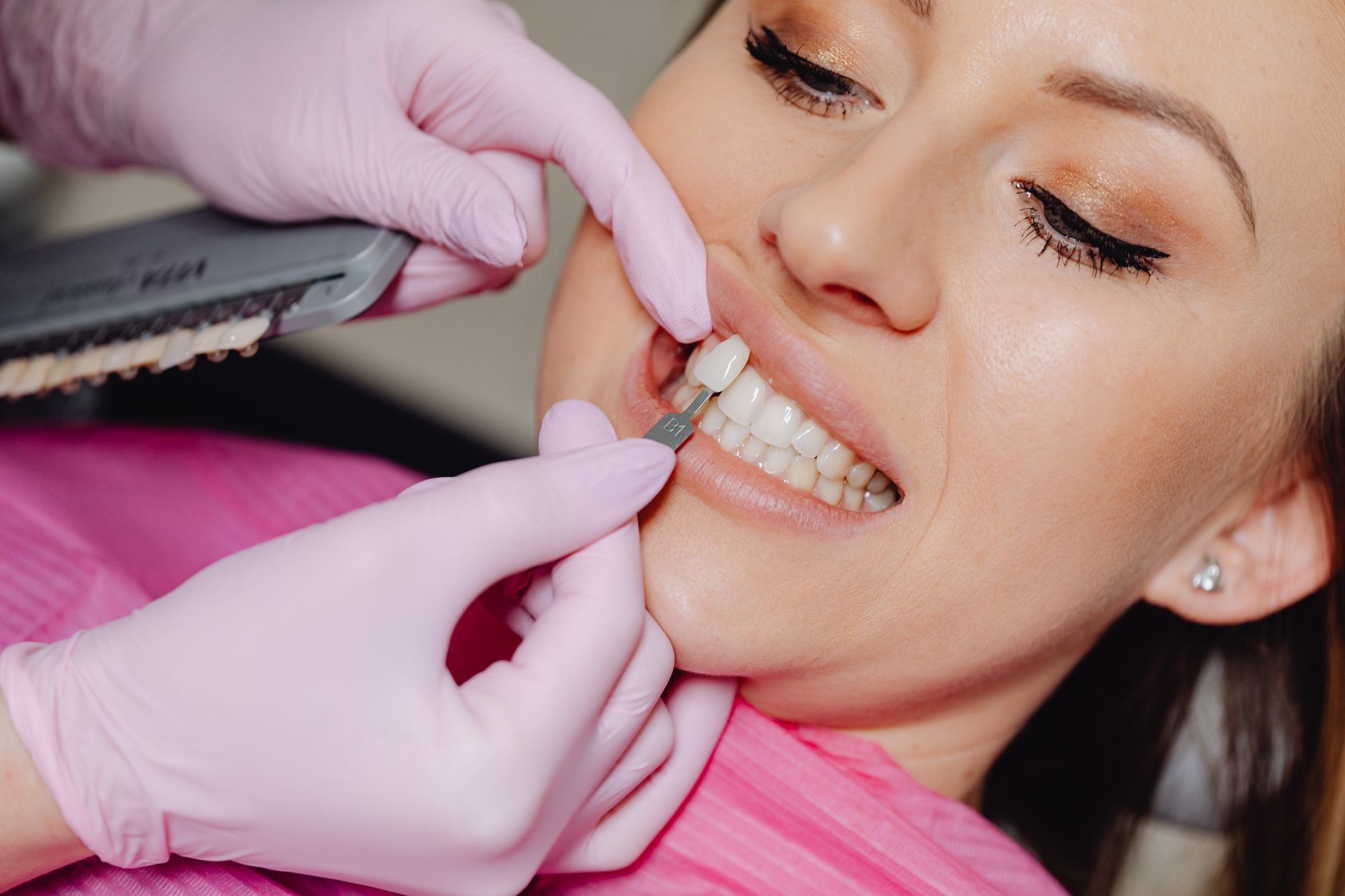 Sourire avant et après la pose d'une facette dentaire montrant l'amélioration de la couleur et de la forme des dents