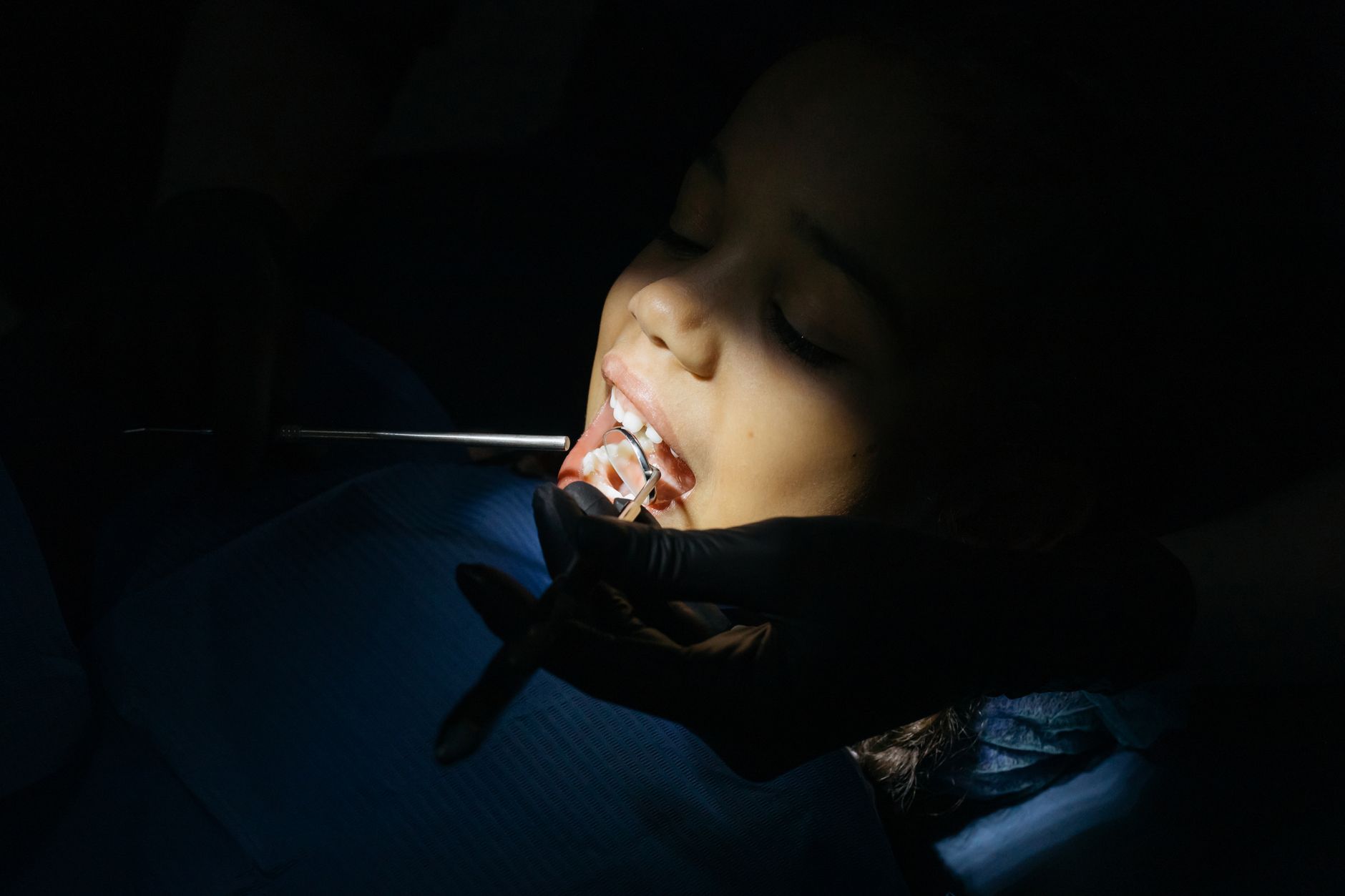 Dentiste examinant les puits et fissures d'une molaire chez un jeune patient avant la pose du scellant