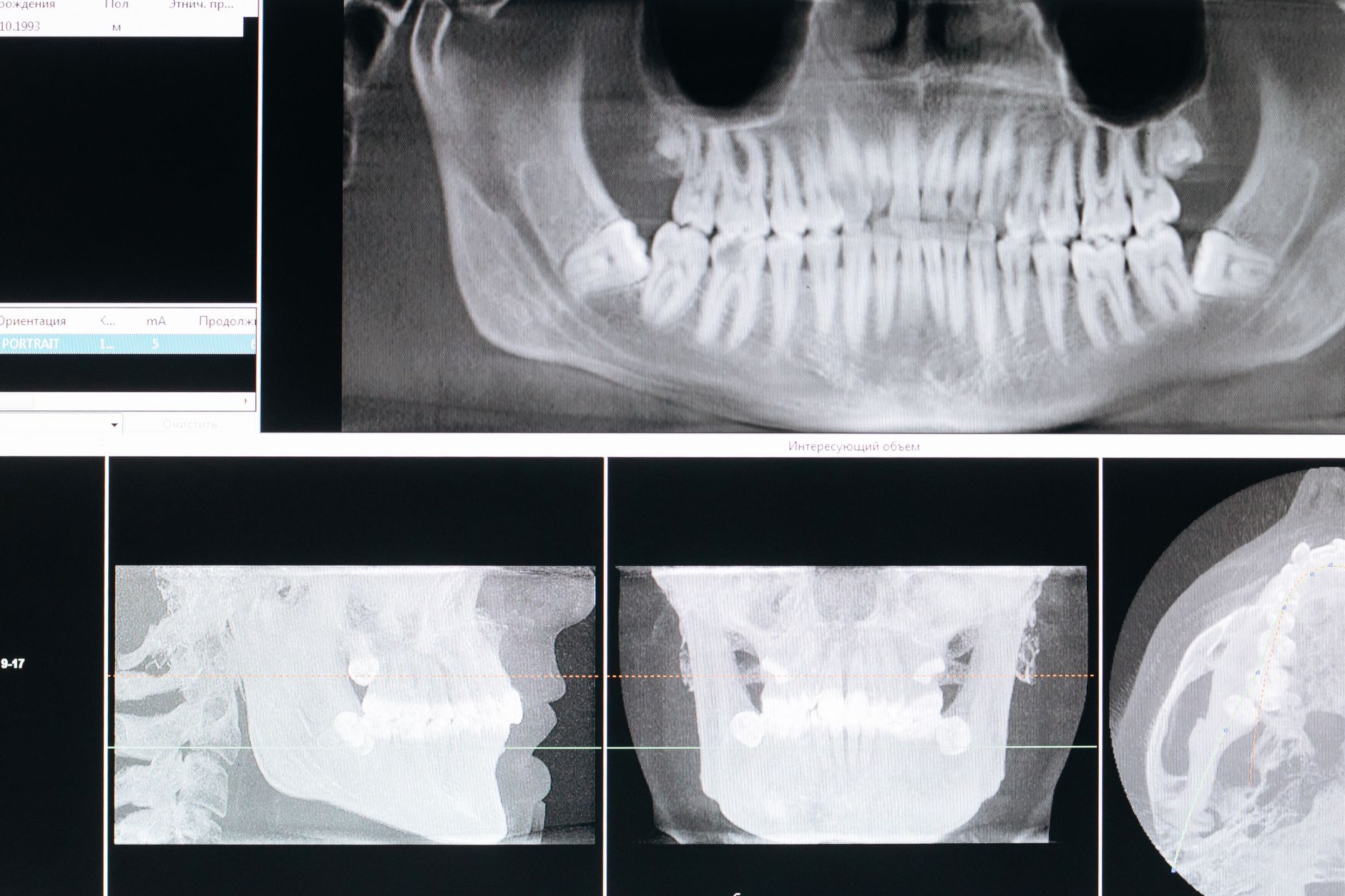 Radiographie dentaire montrant la perte osseuse alvéolaire autour des racines dentaires