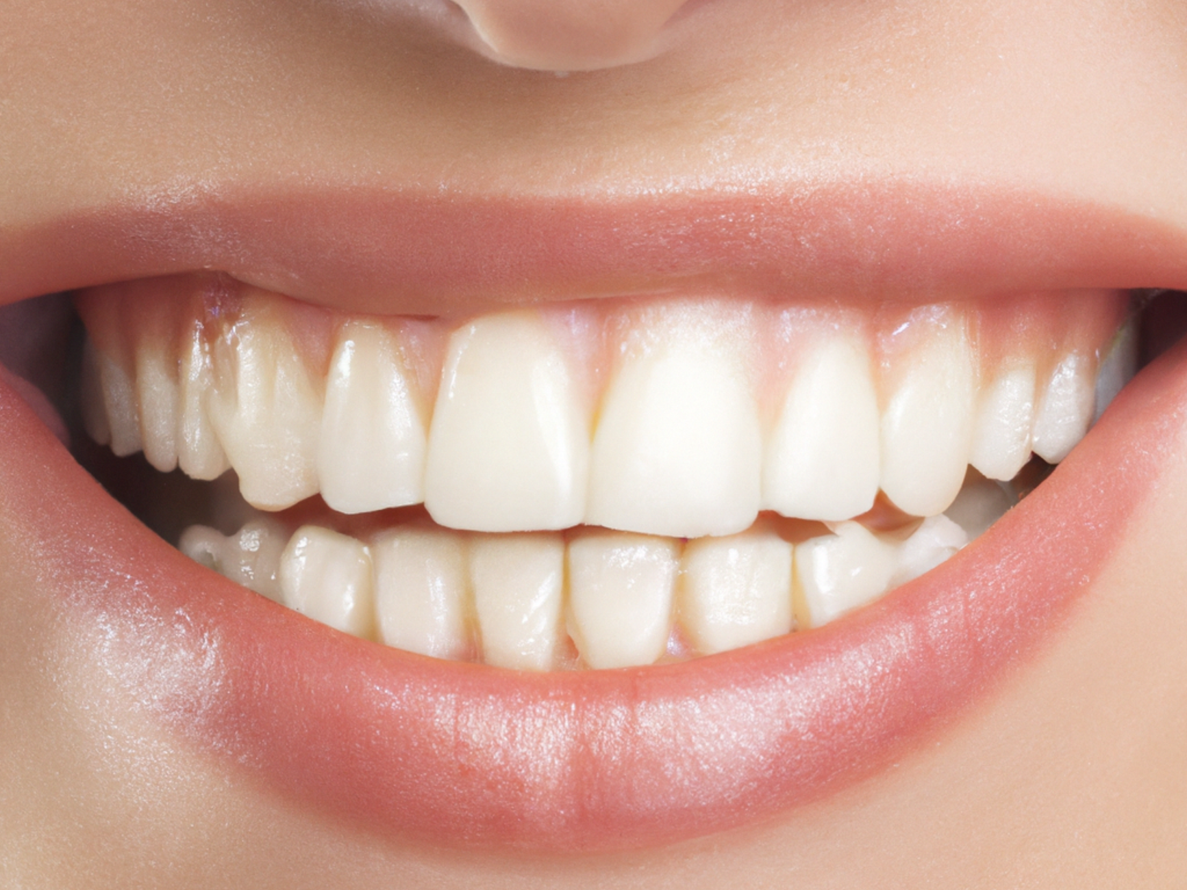 Comparaison avant et après le traitement d'une récession gingivale sur les dents antérieures