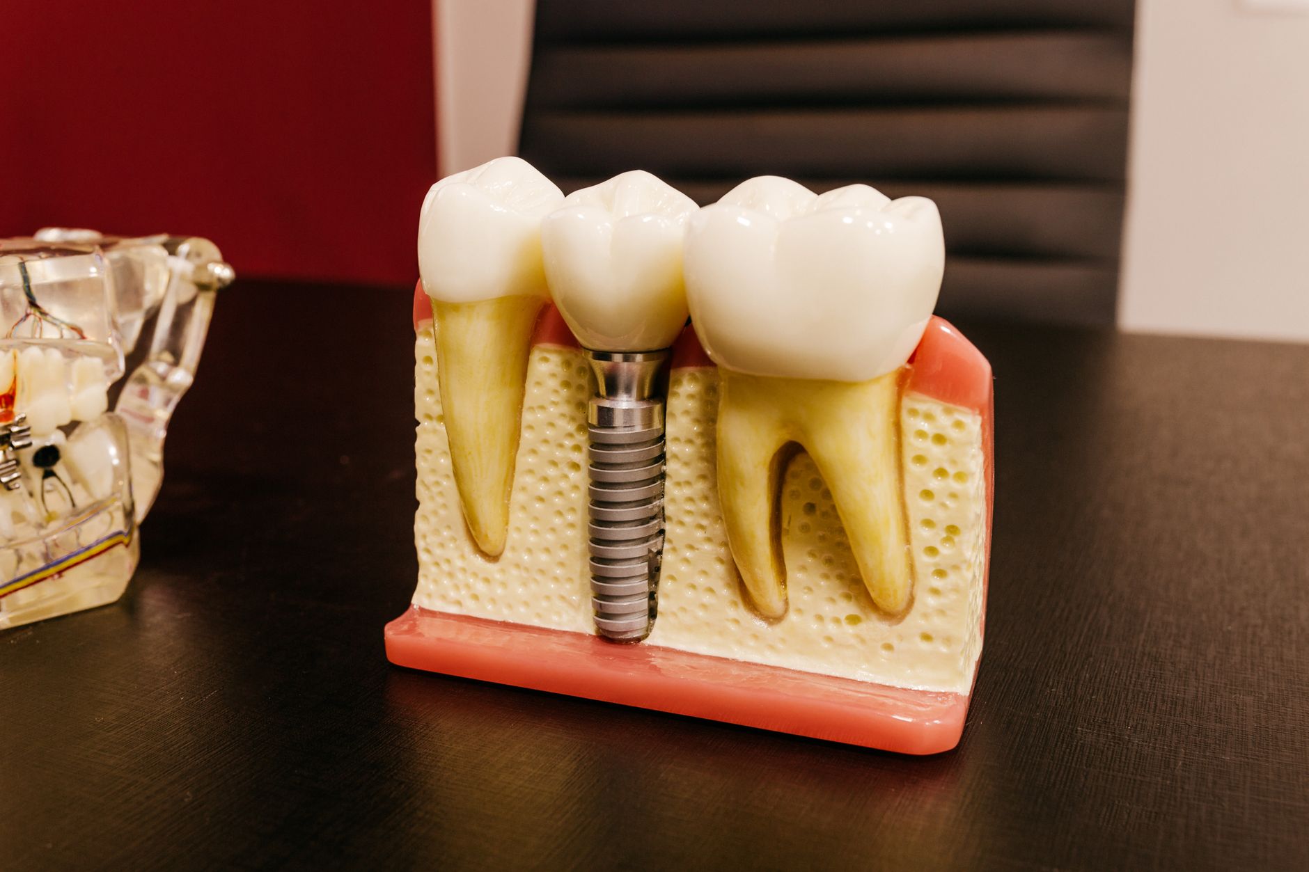 Prothèse amovible du bas stabilisée par une overdenture on 2 implants dans la mâchoire inférieure