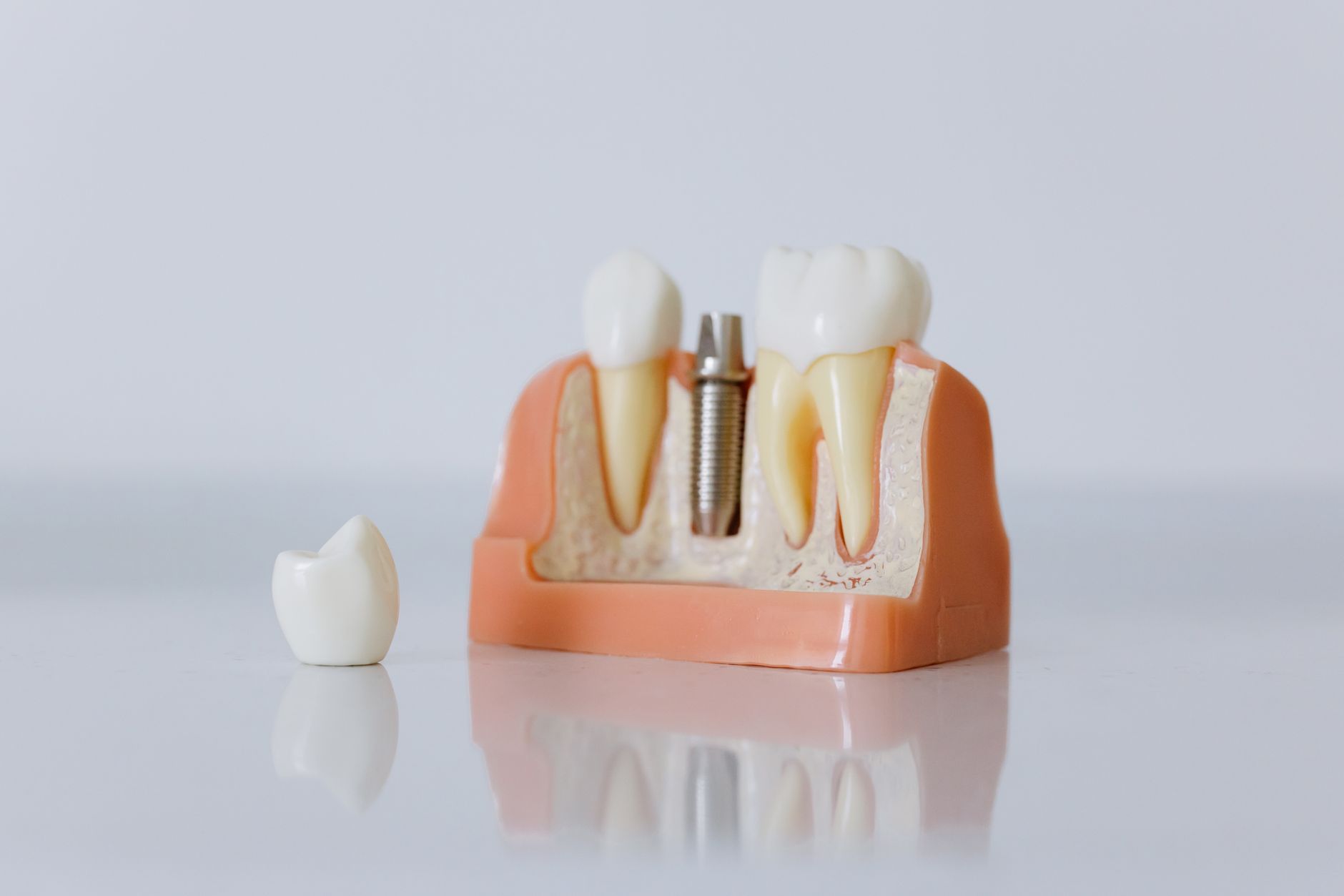 Guide visuel du prix des prothèses dentaires au québec pour prothèses complètes, partielles et sur implants en 2026