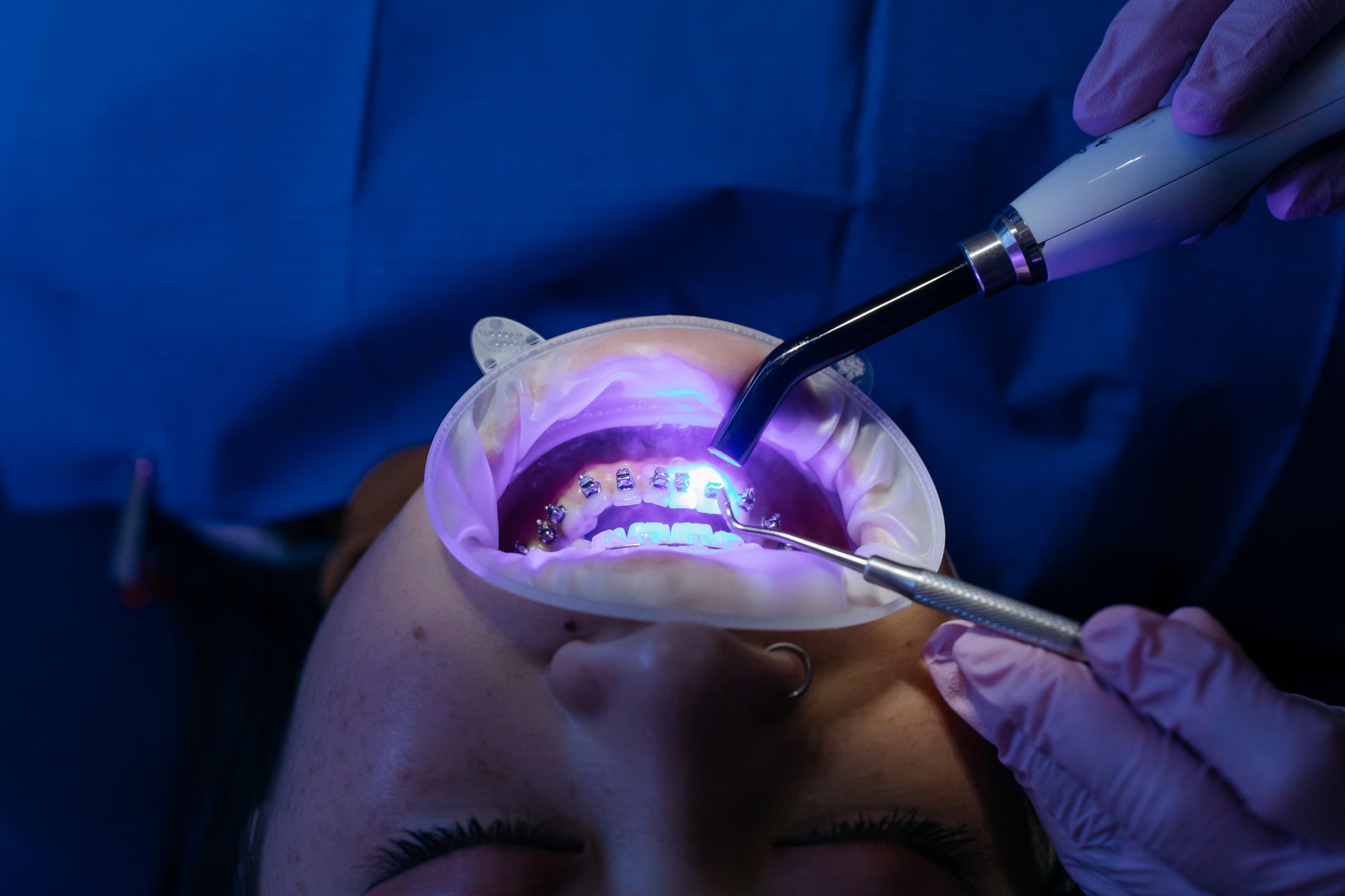 Dental professional applying whitening gel and an LED light during an in-clinic treatment