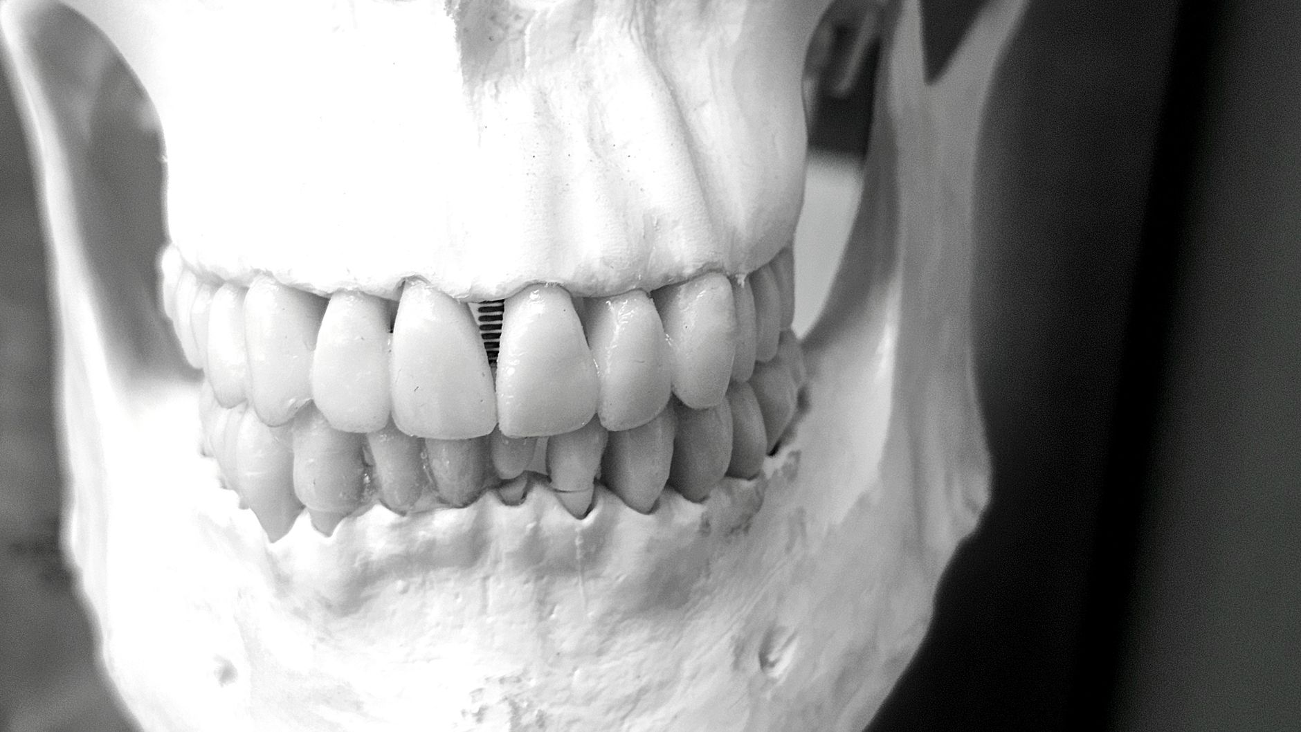 Titanium dental implant post fused into the jawbone supporting a natural ceramic crown