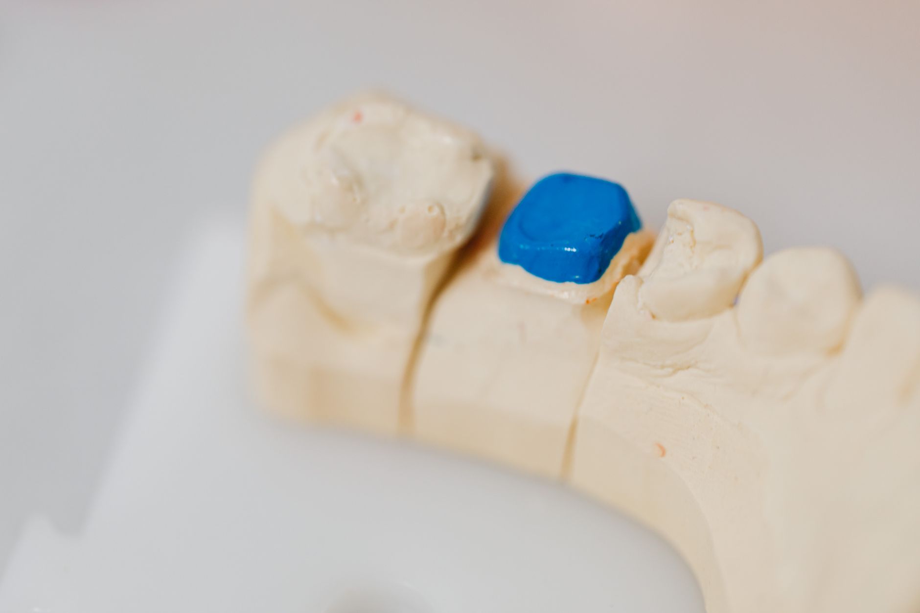 Comparison between a white filling and a ceramic inlay on two back teeth