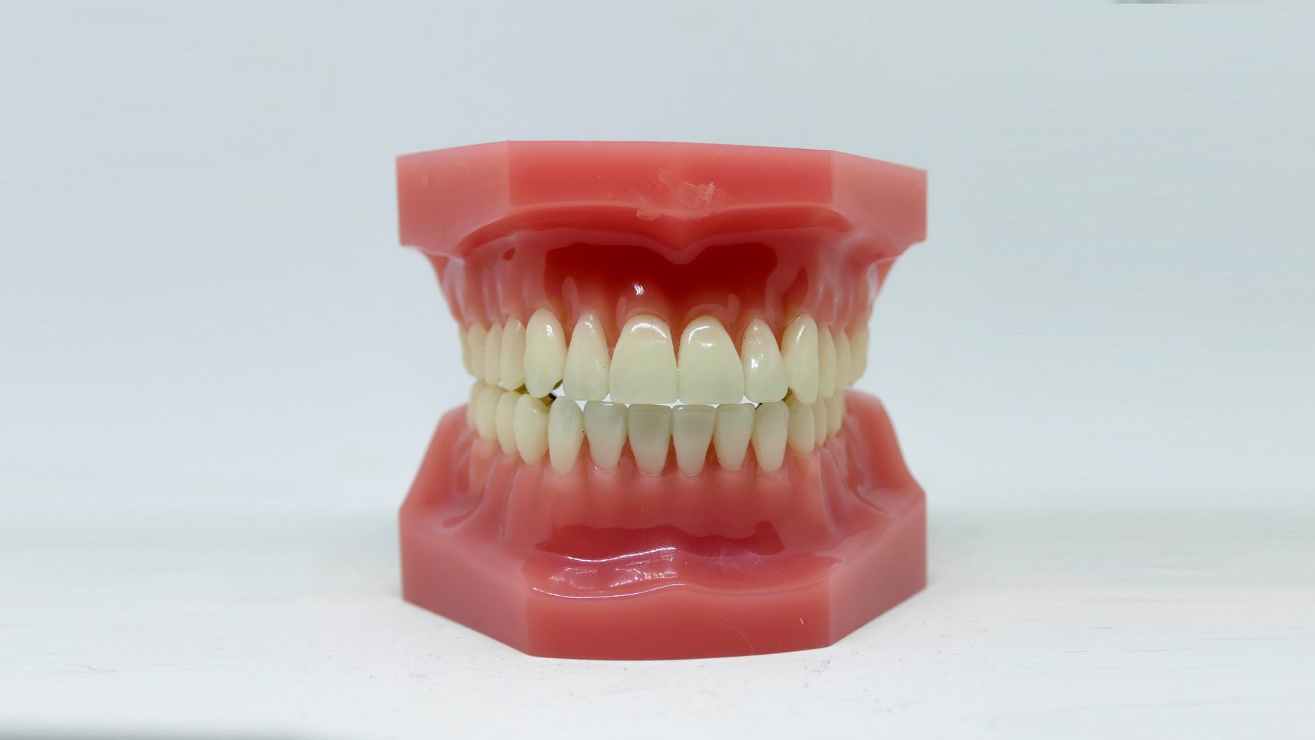 Close-up of a sealed permanent molar showing protective coating over deep chewing grooves