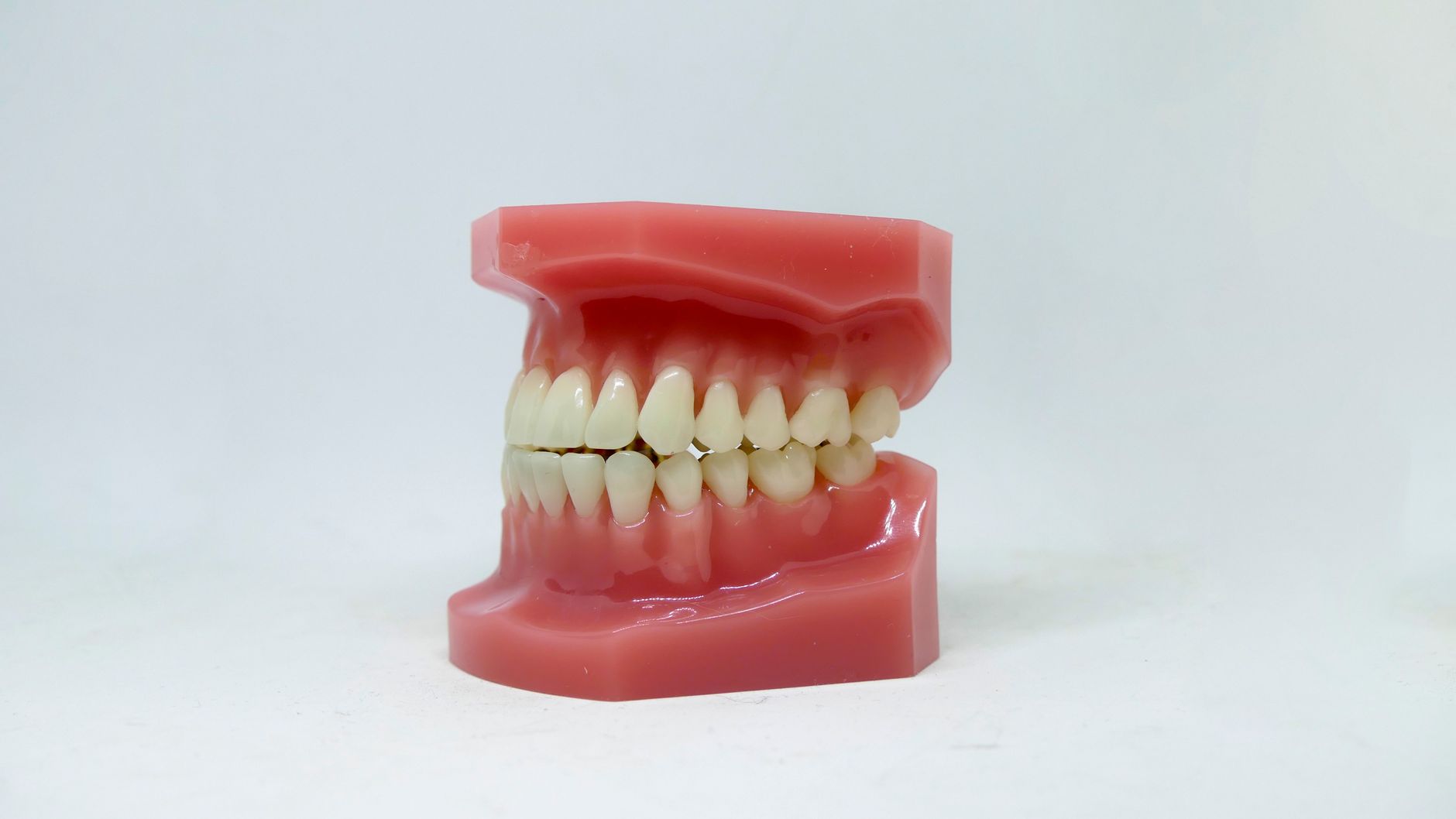 Custom clear occlusal splint resting on a dental model, used to protect teeth from grinding