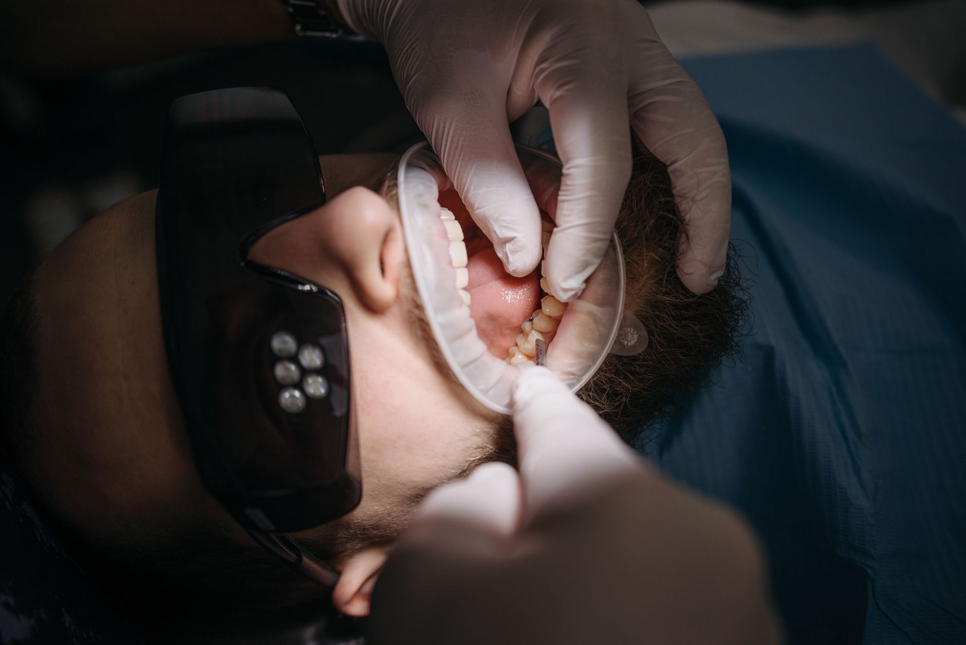 Close view of fine sutures placed on the lower gums after a connective tissue graft procedure